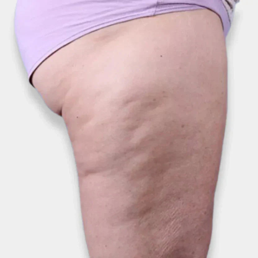 Como combater a celulite?