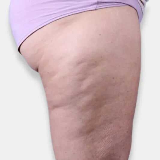 Como combater a celulite?