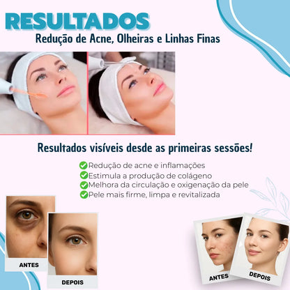 Ionique | DermalGlow HF – Bastão de Alta Frequência com Eletrodos Neon & Argônio para Rosto e Couro Cabeludo