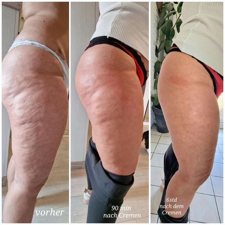 Ionique ModelaBody | Massageador de Drenagem Linfática, Celulite e Inchaço